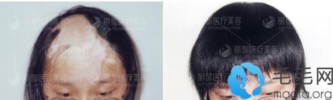 在北京丽都做疤痕种植案例前后效果对比照片