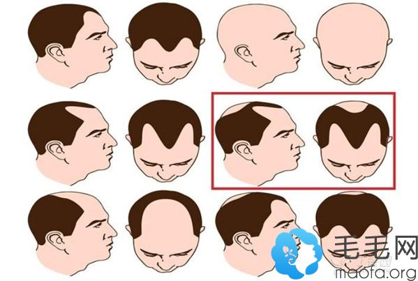 男性雄性激素脱发不同类型