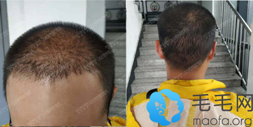 北京薇琳植发窦云轲植发际线一个月效果图