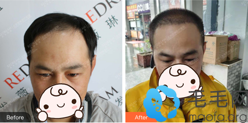 北京薇琳植发窦云轲发际线种植前后对比图