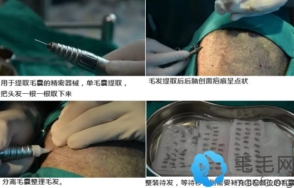 中信惠州医院植发手术中的取发过程
