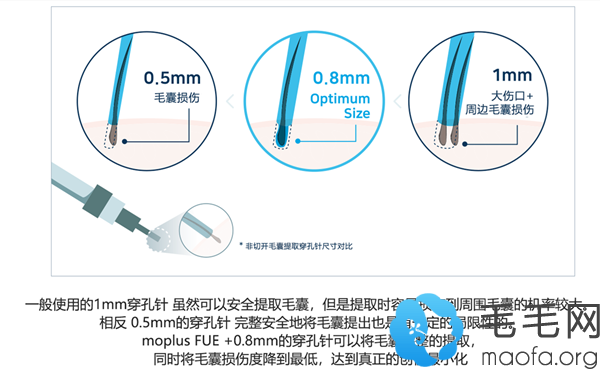 韩国moplus植发医院使用0.8毫米打孔针的原因
