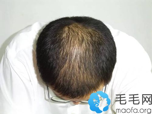 脂溢性脱发的主要表现特征
