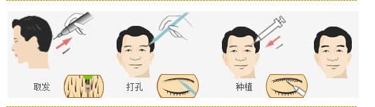 韩国BR-HL微针植眉手术示意图