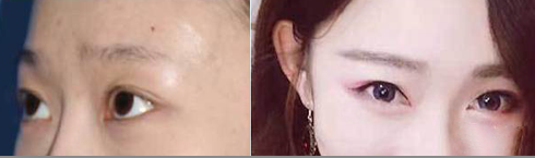 眉毛种植术前术后对比图