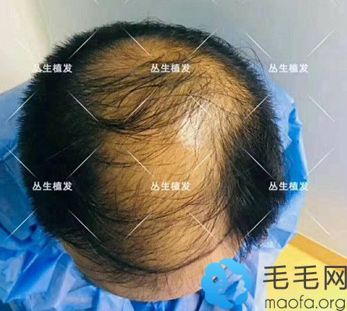 年轻男士头顶u型脱发,分享他大面积加密植发术后恢复过程图