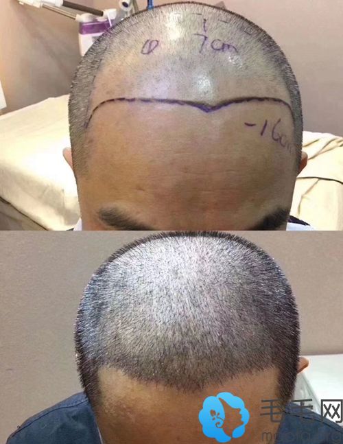 王先生头顶加密植发前后效果对比图