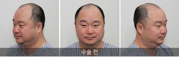 韩国出名植发医院案例:6级脱发加密植发5500根一年后效果