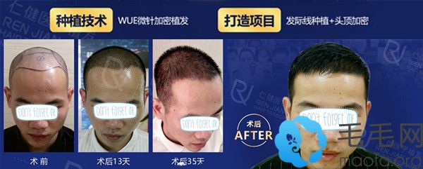 广州仁健发际线种植+头发加密植发实例