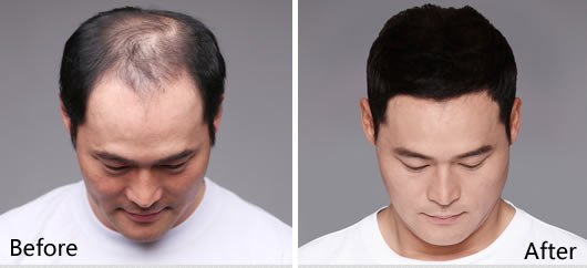 韩国毛杰琳毛发移植中心男性M秃顶植发案例