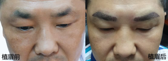 广州荔湾区人民医院毛发移植为男性植眉前后效果对比