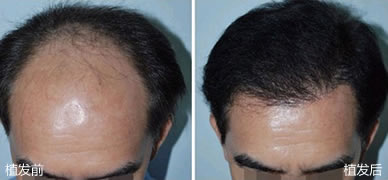 广西南宁华美毛发种植中心男性种植头发案例