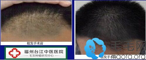 福州台江中医院毛发种植中心男性植发手术案例效果