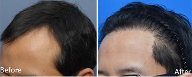 韩国theblack植发男性发际线前后对比案例