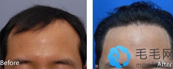 韩国theblack植发男性发际线调整手术效果对比图