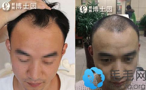 北京博士园毛发研究中心 脂溢性脱发患者植发经历