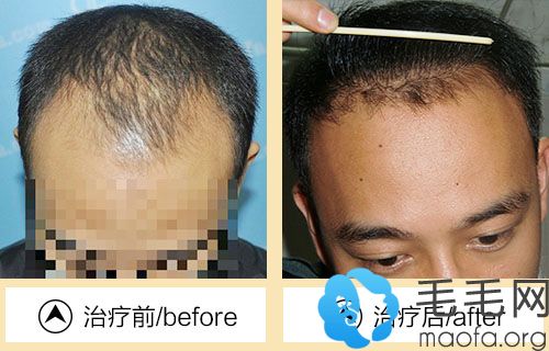 北京中美恒恩植发中心为男性发际线调整手术案例
