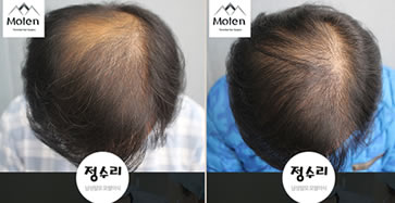 韩国毛腾毛发移植案例 男性脱发头顶种植1800毛囊
