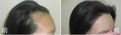 韩国毛林毛发移植中心女性发际线矫正效果
