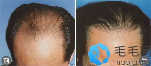 西安西医植发案例Ⅳ级脱发患者接受手术一年后效果