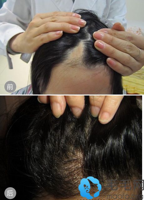 武汉美基元医院采用M-FUE技术帮马女士解决了疤痕性脱发