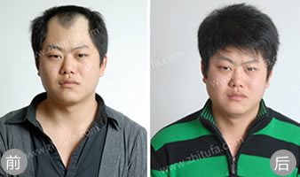 郑州陇海毛发移植案例 植发手术一年后效果满意