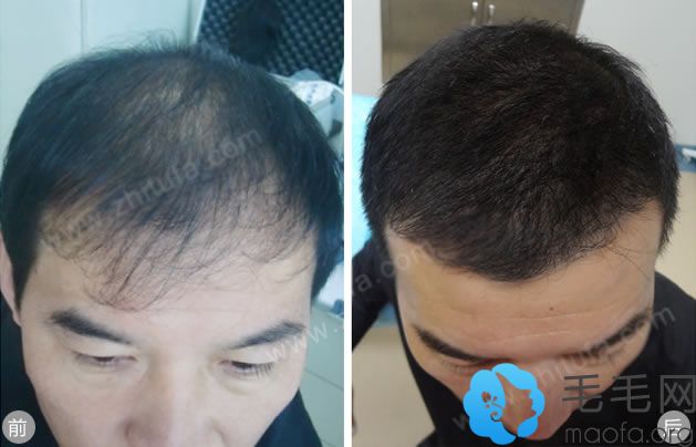 郑州陇海植发案例 男性脱发患者植发手术前后效果对比