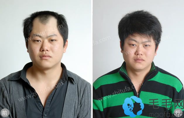 郑州陇海毛发移植案例 植发手术一年后效果对比