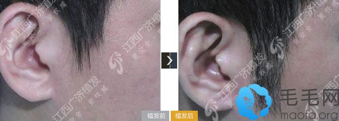 江西广济医院毛发移植案例 鬓角加长种植手术8个月后效果