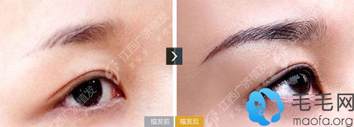 江西广济医院毛发移植案例 女性半截眉种植术后一年的效果