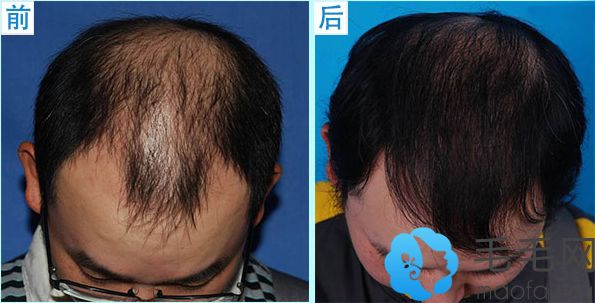 杭州市人民医院植发案例 男性秃顶植发效果
