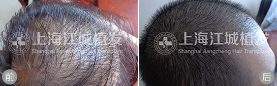 上海江城医院植发案例之植发手术治疗男性脱发前后效果