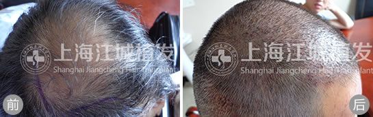 IT主管在上海江城医院毛发移植中心接受植发手术当天的效果对比