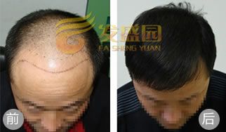 张先生植发手术前后效果对比