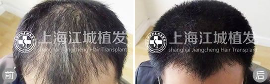 上海江城医院植发案例 头发稀疏选择植发半年后效果