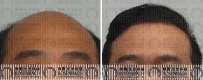 广州乐鬓植发案例 植发手术治疗秃顶