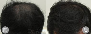 韩国安医生毛发移植案例 男性头顶加密植发手术