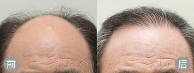 韩国安医生毛发移植案例 男性秃顶植发手术效果