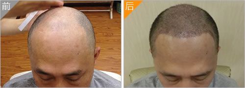 太原丽都植发案例之男性秃顶进行植发手术效果