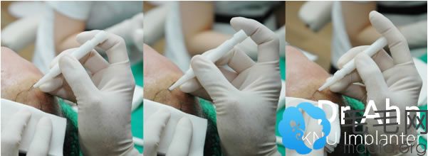 韩国安医生毛发移植医院使用KNU植毛机
