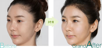 韩国高兰得植发案例 3D女性植发术治疗脱发