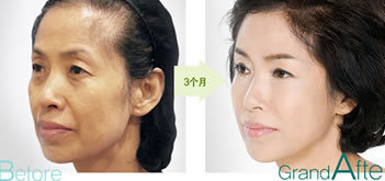 韩国高兰得植发案例 女性自体毛发移植治疗脱发
