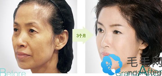 韩国高兰得女性自体毛发移植治疗脱发