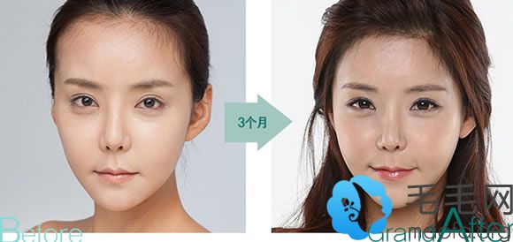 韩国高兰得植发案例女性发际线调整脸型效果