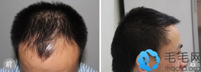 杭州格莱美毛发移植中心植发手术效果对比图
