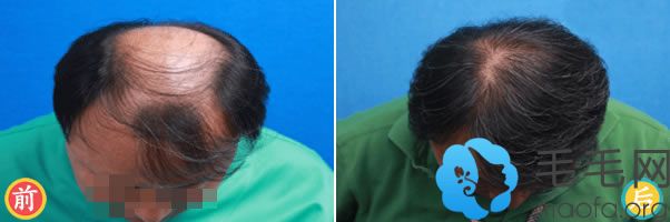 韩国毛爱林医院为男性秃顶实施植发手术效果