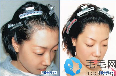 石家庄博士园实施女性头发加密植发手术