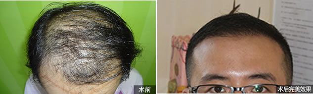 重庆重生植发案例 秃顶教师重返青春