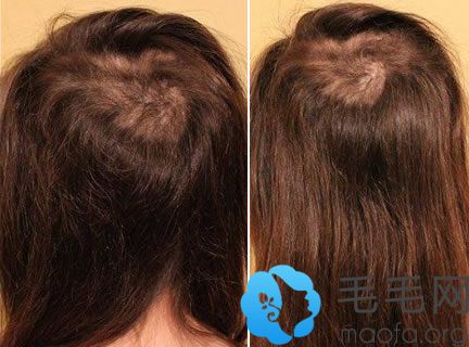 拔发助长的研究结果表明拔头发治疗脱发目前没效果