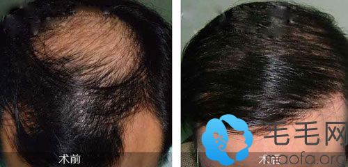 植发治疗脱发秃顶的效果真的是的吗？